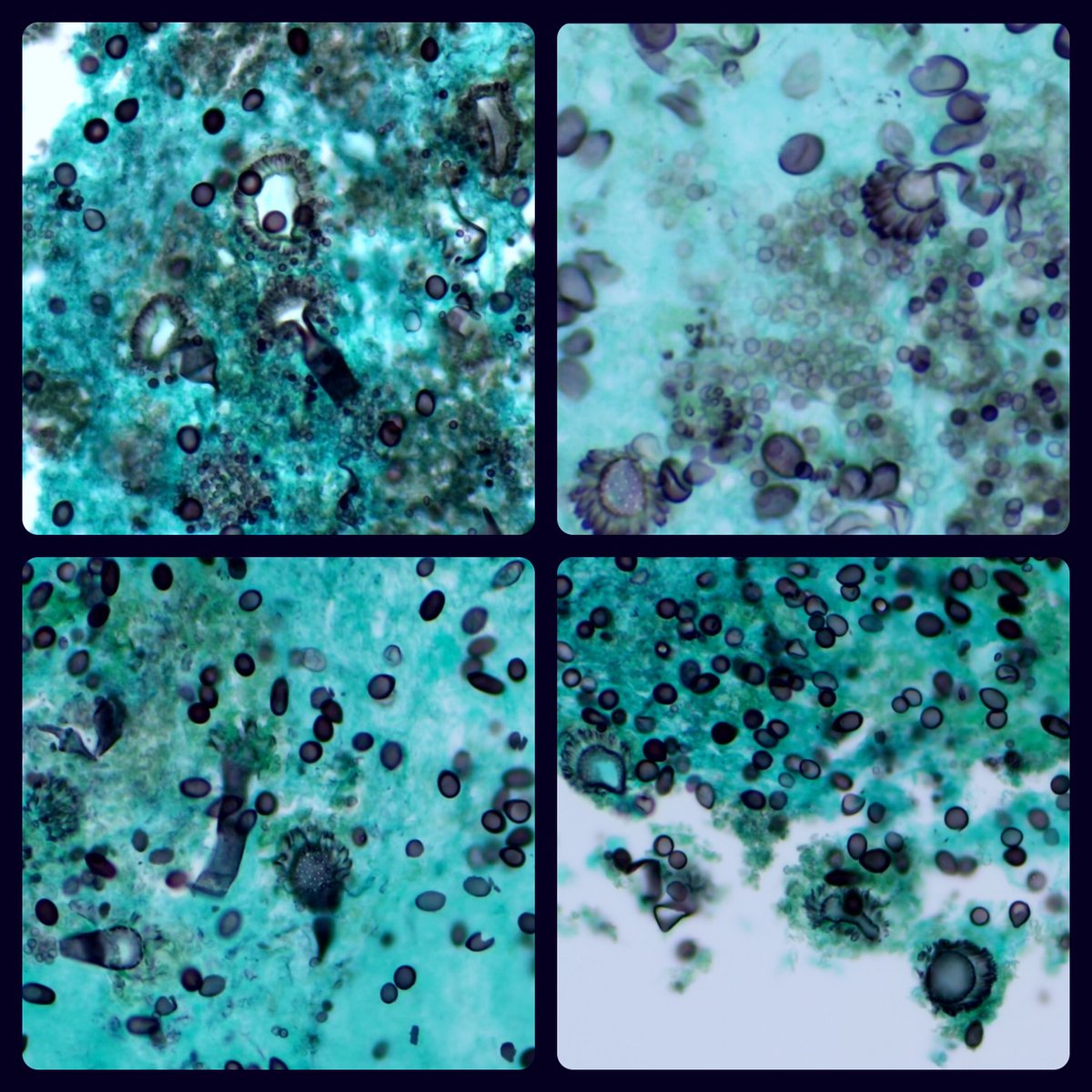 #ENTpath #IDpath

Sinonasal contents; GMS stain showing Aspergillus conidia (fruiting bodies).