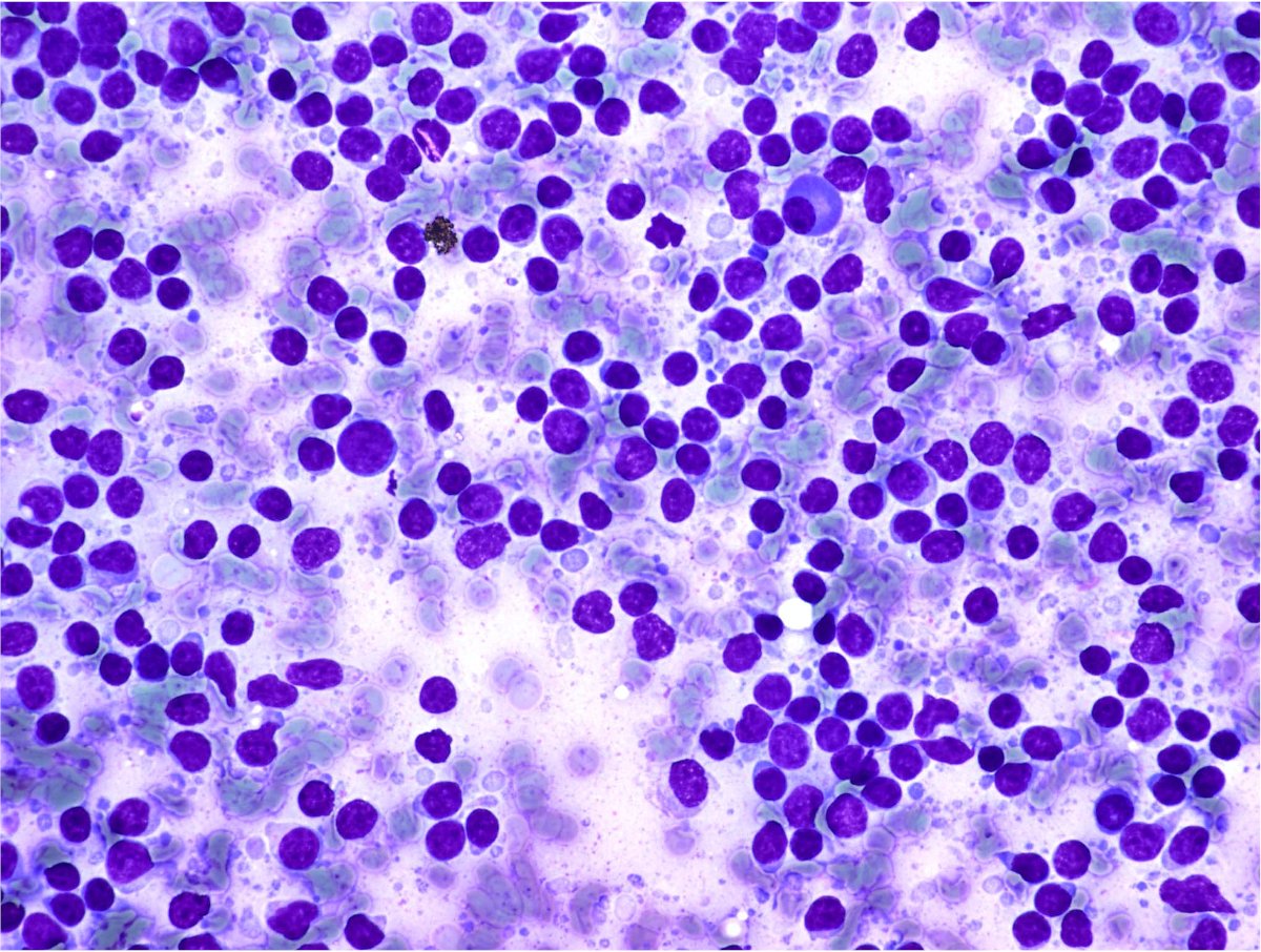 LN interpretation can be very difficult. I'll show you cases once a week. It's all about common sense. High grade lymph are usually evident. Low grade not so. Grade 2 follicular lymphomas can be challenging. What's your opinion of this image, is it reactive or not? answer below