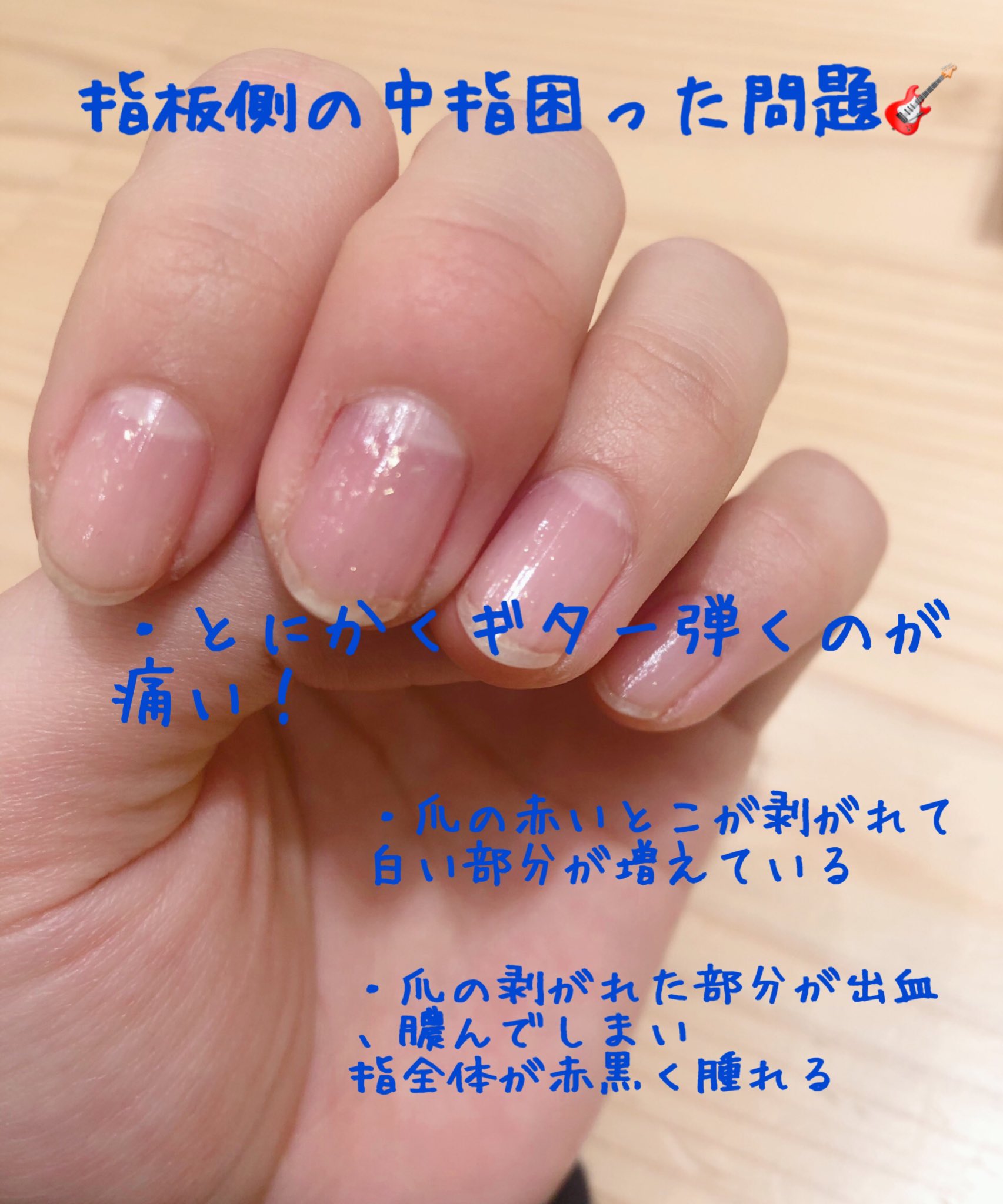 تويتر 大塚紗英 على تويتر ギター弾いてるとすぐなるんですが 困ってます いい保護の仕方あったら教えてください 体質的にどうやら爪が剥がれやすく とにかく痛くて困ってます 笑 チョーキングとか早弾きとかで特になります ちなみに1日あたりの練習