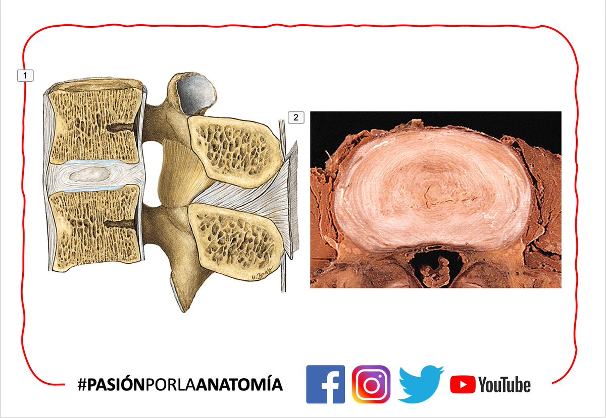 El disco intervertebral se puede herniar en cualquier dirección, pero en la mayoría de las ocasiones lo hace en dirección posterolateral. Os cuento por qué🧵⤵️