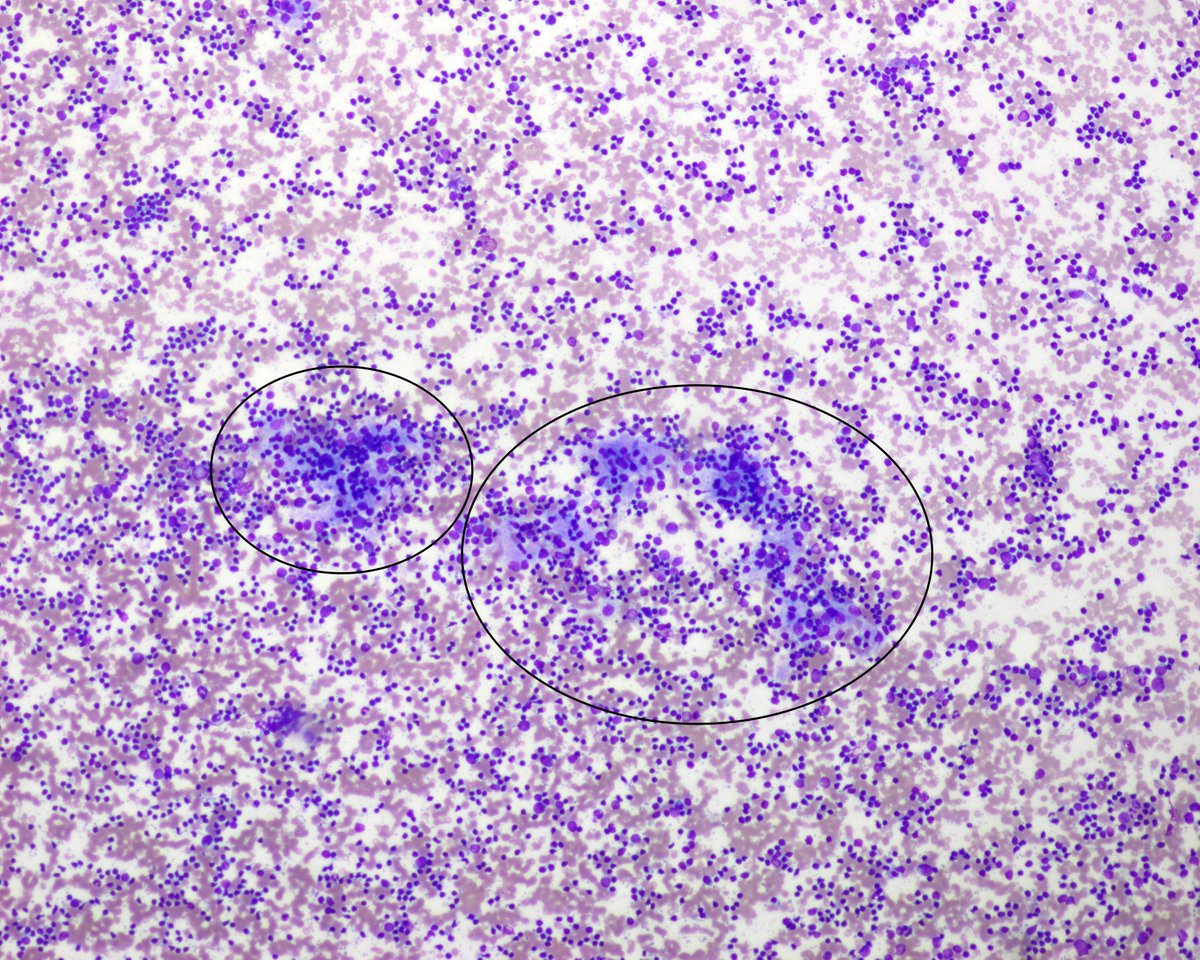 Can we see germinal centers of fragments of GC, as  @PhilippeCytoMD cleverly mentioned? YES. You willl see them as ill-defined aggreagates of FDC intermixed with lymphos and Mphs. Don't misinterpret them as granulomas.  #pathresidents  #cytopath