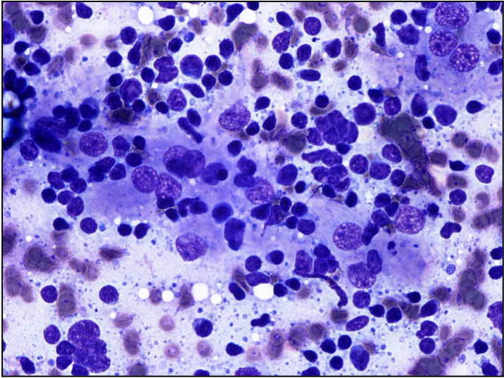 Great image of a fragment of a GC with beautiful FDCs this time unaccompanied of tingible body macrophages (left). The difference between a FDC and a Mph is not clear cut, some can be non-phagocytic macrophages. But this is not a granuloma. The one at the right is a granuloma