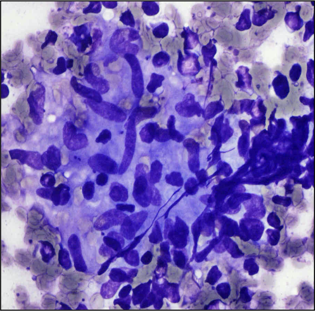 Great image of a fragment of a GC with beautiful FDCs this time unaccompanied of tingible body macrophages (left). The difference between a FDC and a Mph is not clear cut, some can be non-phagocytic macrophages. But this is not a granuloma. The one at the right is a granuloma