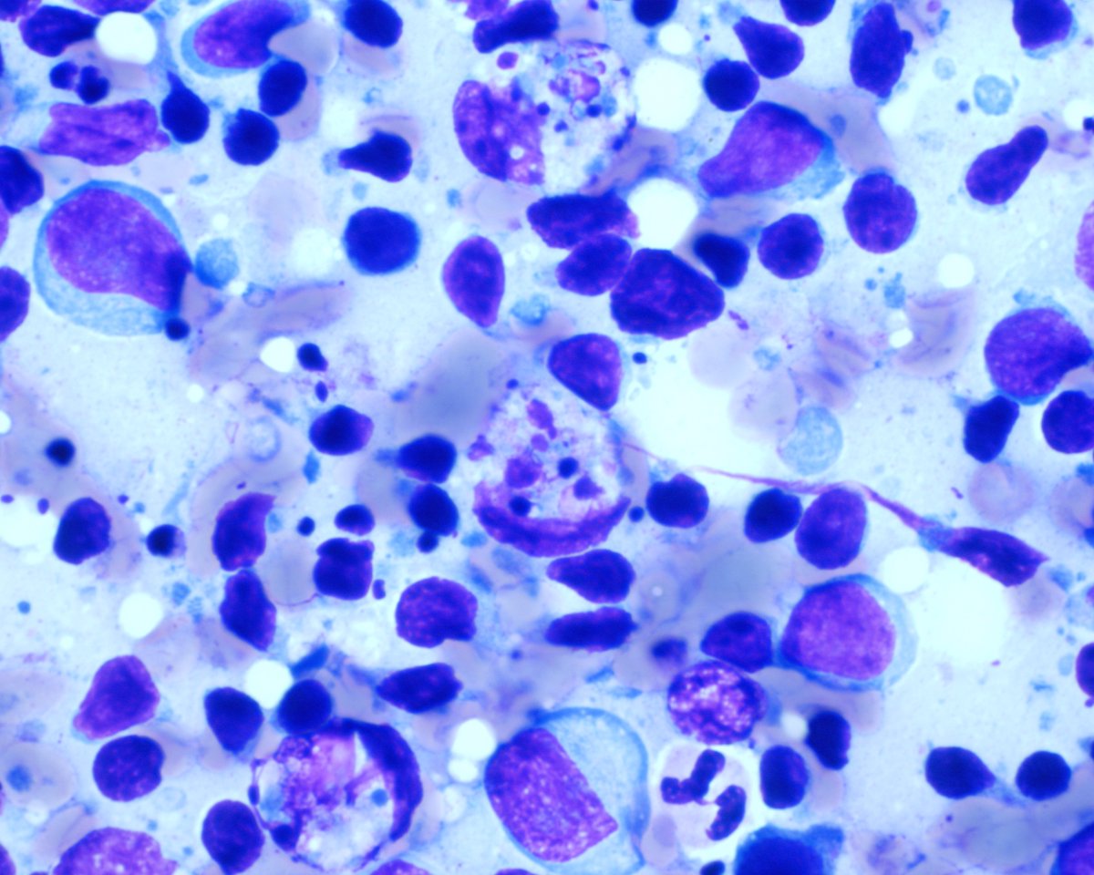 From my mentors. Great images of tingible body Mphs. Low grade lymphomas rarely show a relevant number. Don't misinterpret the as Kikuchi Mphs. These are much smaller with crescent-like shape (right). Recognize centroblats and immunoblasts in Kikuchi ?