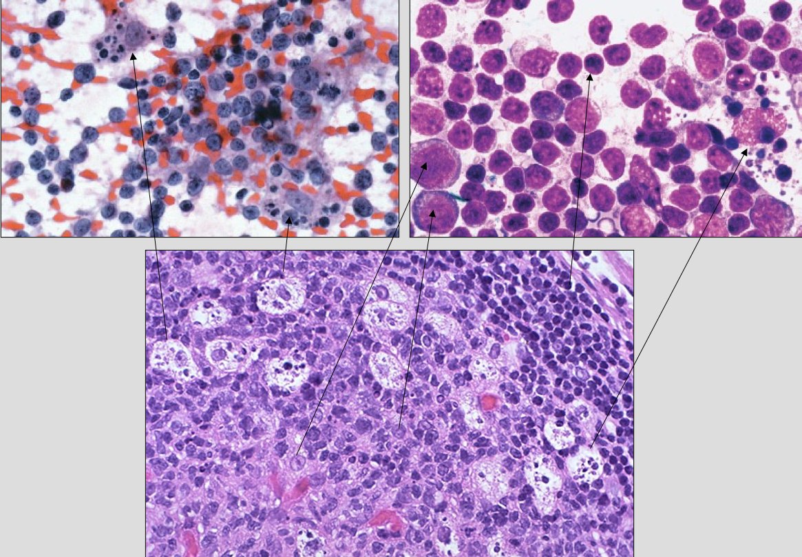 What about tingible body Mph ? Also characteristic of an active GC. They are present, or at least relevant, when follicular hyperplasia is the predominant pattern. If paracortical pattern predominates you will not see them. Correlation with histology, also of centroblasts