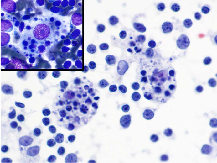 From my mentors. Great images of tingible body Mphs. Low grade lymphomas rarely show a relevant number. Don't misinterpret the as Kikuchi Mphs. These are much smaller with crescent-like shape (right). Recognize centroblats and immunoblasts in Kikuchi ?