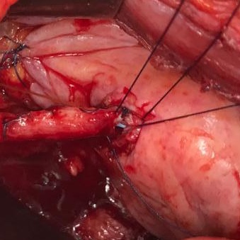Carara_Daniel's tweet photo. First reconstructive surgery of 2021: left ureteral reimplantation.

#urology
#suregery
#ureteralreimplantation https://t.co/Mk0hqTzegJ