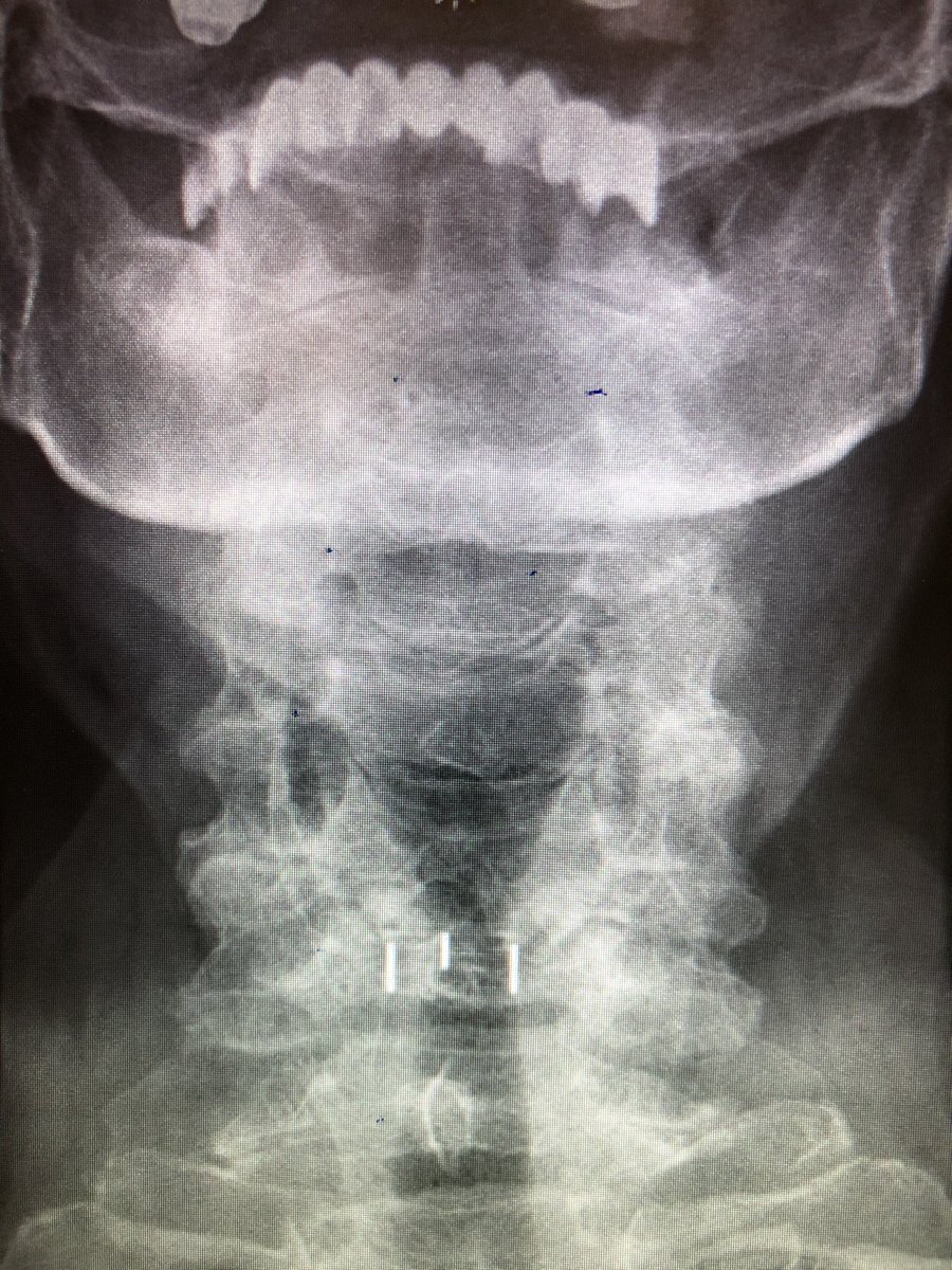 Dr_Faizo's tweet photo. #Cervical disc replacement https://t.co/wL3nBxGflT