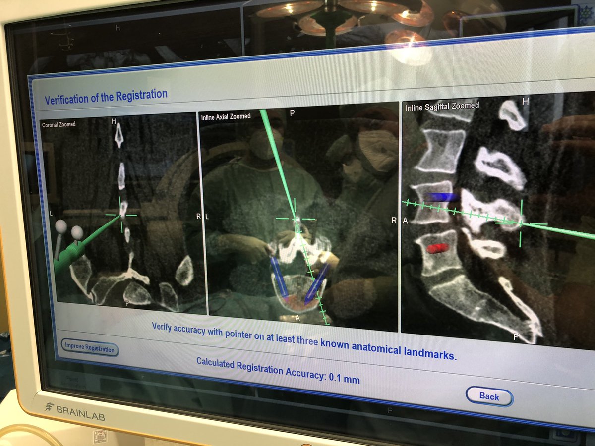 Dr_Faizo's tweet photo. This is how accurate you can go with navigation 0.1 mm 
Sadly it doesn’t go smoothly all the time like this https://t.co/2wnjsVrAMD