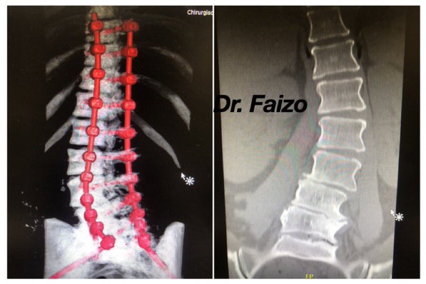 Dr_Faizo's tweet photo. One one the #scoliosis cases 
Which I love to do even without navigation https://t.co/LUet33qJXM