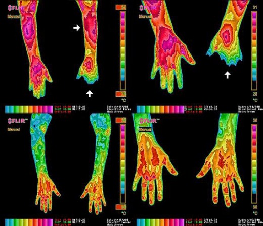Attached are images of the effects of sleeping grounded. Showing the reduction in inflammation throughout your body using grounded sheetsCredits:  @NgoloTeslaMore Studies  https://twitter.com/NgoloTesla/status/1287101910168805380