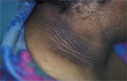 SIMPHIWESANDIL6's tweet image. Acanthosis nigricans is a confidence killer. My heart goes out to all teenagers suffering from this condition.