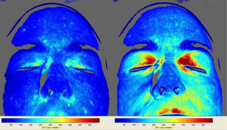 Attached are images of the effects of sleeping grounded. Showing the reduction in inflammation throughout your body using grounded sheetsCredits:  @NgoloTeslaMore Studies  https://twitter.com/NgoloTesla/status/1287101910168805380
