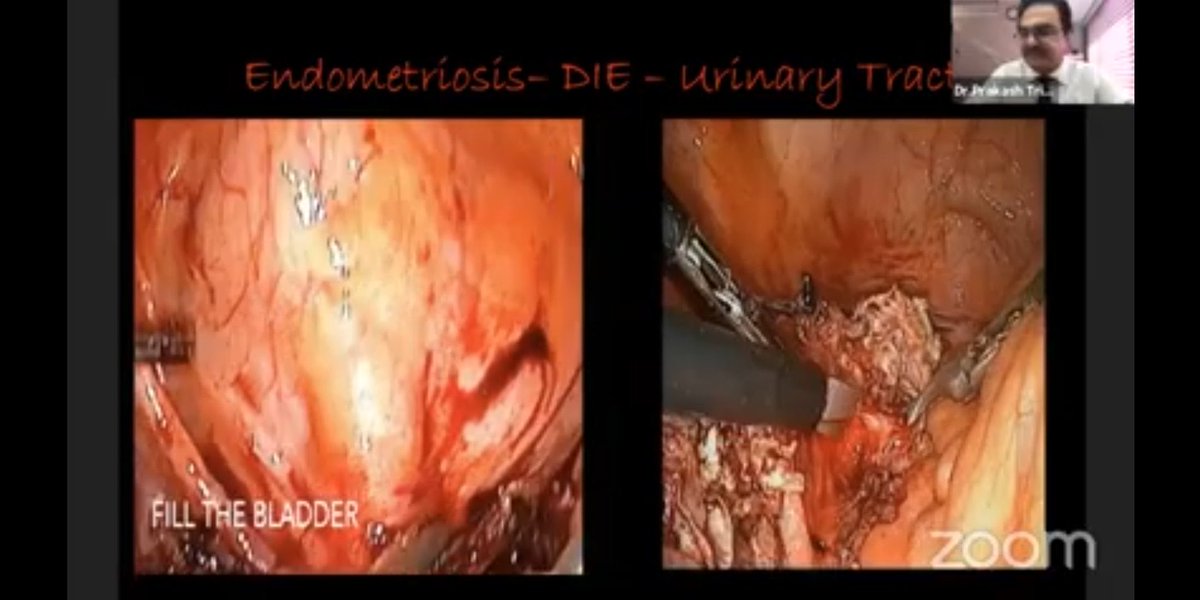 BoobManan's tweet image. @niru22 #highgrad #ART #IVFcourse #sciencematter #obgy #IVF Laparoscopy in ART very nicely explained!