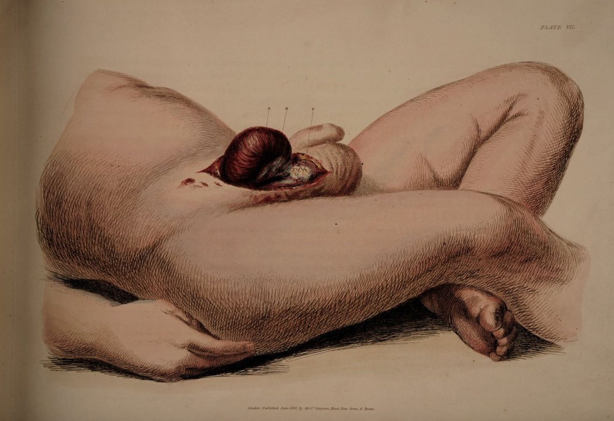 [5/7] With bacteriology in its infancy in the early 19th century, a patient was in greater danger of dying from a postoperative infection than from the surgery itself (unless they were in the hands of a clumsy surgeon ).