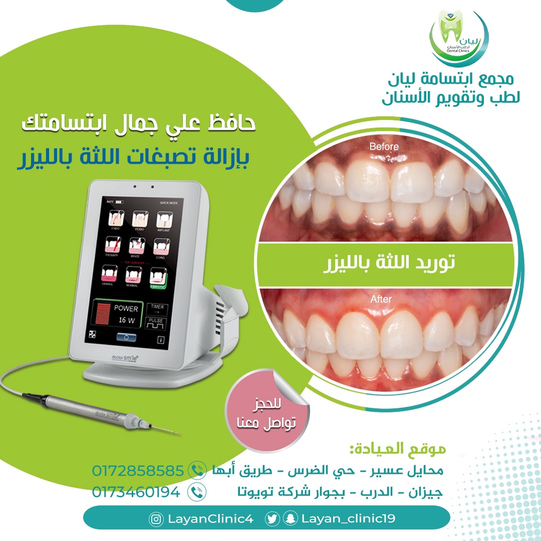 Layan_clinic19's tweet photo. ،#فينير #فينيرز #فينير_اسنان #فينير_متحرك #فينيرزر #فينير_الاسنان #veneers_smile #سناب_اون_سمايل #سناب_أون_سمايل #سناب_سمايل #تبييض_اسنان #تبييض_أسنان #تبيض_أسنان https://t.co/b4ly0n8CrC