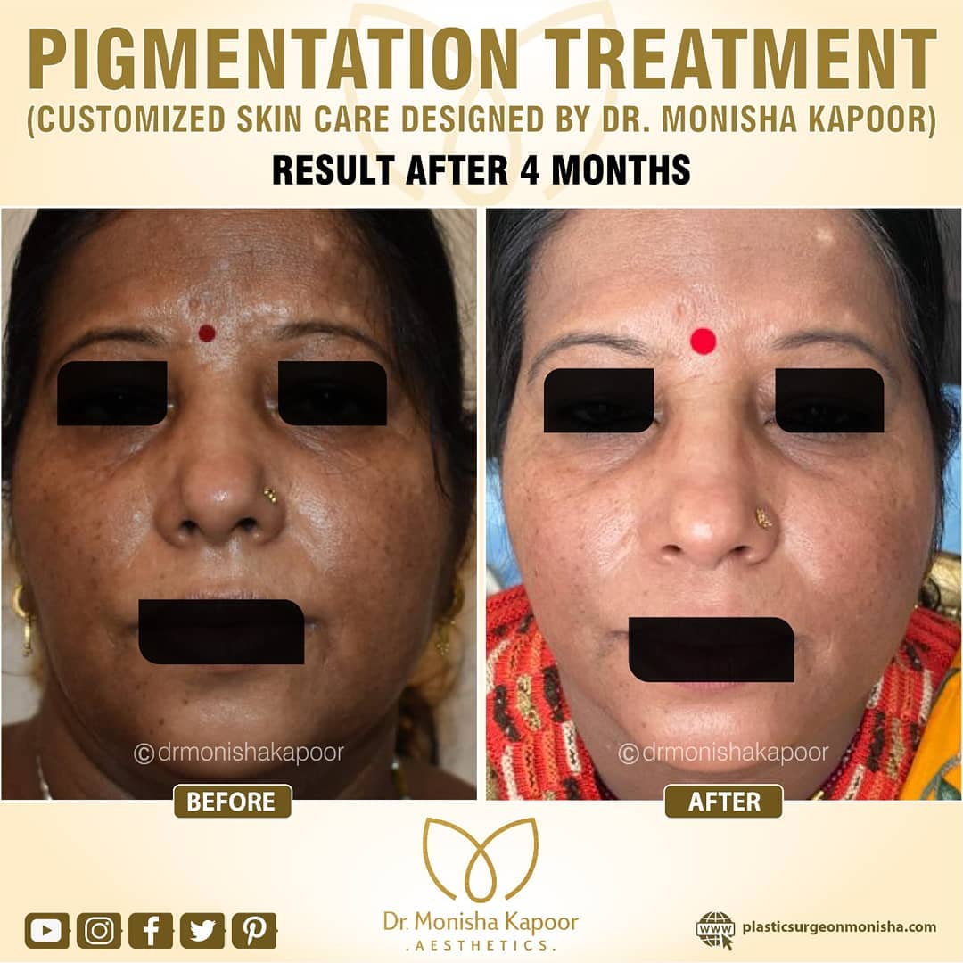 This beautiful client has had a series of treatments and products designed by Dr Monisha Kapoor. This particular result showcases the importance of customized skin treatment protocol. 
#pigmentationtreatment #pigmentationsolution #pigmentation #pigmentationremoval #skinpigment