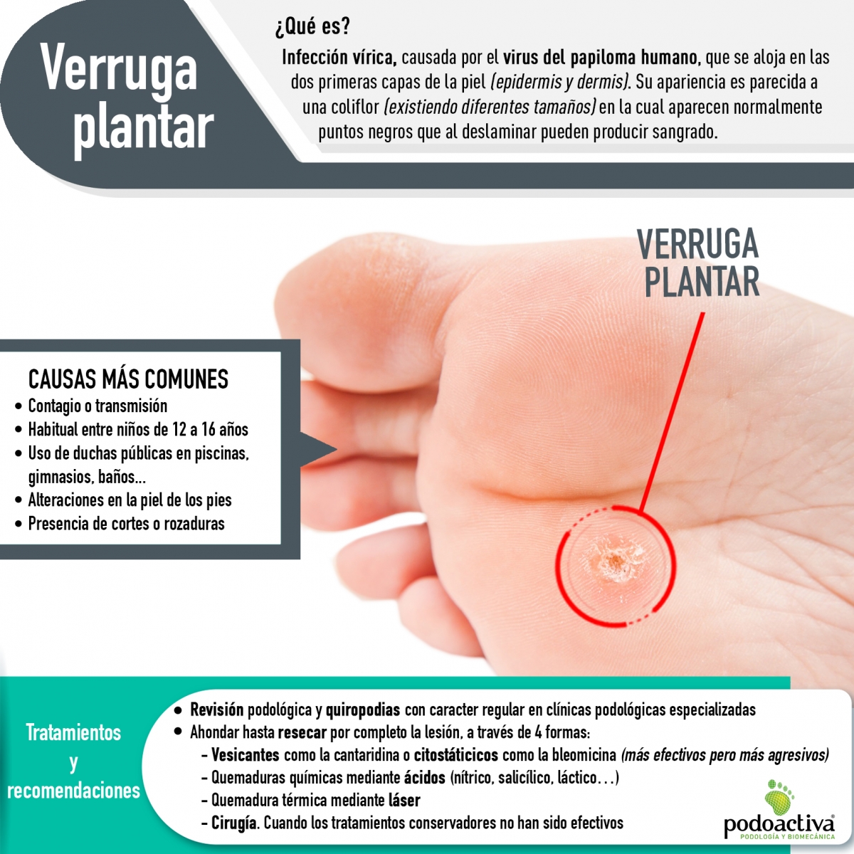 Podoactiva's tweet photo. Las #verrugas o #papilomas en los #pies son una #infección frecuente entre la población. Te contamos qué son, cómo tratarlas y qué medidas tomar para evitar su #contagio y/o problemas mayores. #Podología #Salud #Verruga
+Info en nuestro blog: https://t.co/cvXe6TGrRK https://t.co/Sdn2ZSWcqB