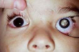 #1RETINOBLASTOMA: KANSA HATARI YA MACHO KWA WATOTO.° Ni kansa hatari sana inayoanzia kwenye sehemu ya hicho iitwayo RETINA° Ni kansa inayowapata zaidi watoto wa chini ya miaka mitano° Huathiri wastani ya watoto 11 kwa kila watoto milioni 1 wenye umri wa miaka 5. #UZI