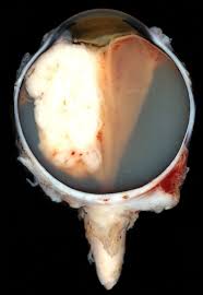 #1RETINOBLASTOMA: KANSA HATARI YA MACHO KWA WATOTO.° Ni kansa hatari sana inayoanzia kwenye sehemu ya hicho iitwayo RETINA° Ni kansa inayowapata zaidi watoto wa chini ya miaka mitano° Huathiri wastani ya watoto 11 kwa kila watoto milioni 1 wenye umri wa miaka 5. #UZI