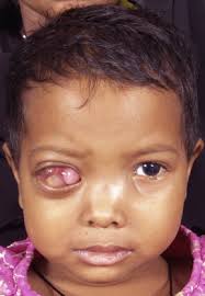 #1RETINOBLASTOMA: KANSA HATARI YA MACHO KWA WATOTO.° Ni kansa hatari sana inayoanzia kwenye sehemu ya hicho iitwayo RETINA° Ni kansa inayowapata zaidi watoto wa chini ya miaka mitano° Huathiri wastani ya watoto 11 kwa kila watoto milioni 1 wenye umri wa miaka 5. #UZI