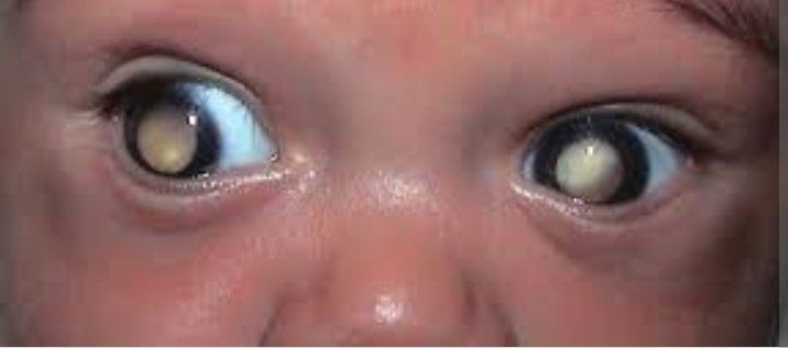 #2°Dalili ya awali ya kansa hii ni mtoto kuwa na kitu CHEUPE jichoni kinachong'aa hasa wakati wa giza (tazama pichani).Jicho moja au yote yanaweza kuathirika°Watoto wengi hupelekwa hospitali katika hatua mbaya,kwani wanakuwa hawajua kuwa mtotowao ana tatizo la kansa ya jicho.