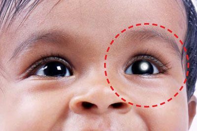 #2°Dalili ya awali ya kansa hii ni mtoto kuwa na kitu CHEUPE jichoni kinachong'aa hasa wakati wa giza (tazama pichani).Jicho moja au yote yanaweza kuathirika°Watoto wengi hupelekwa hospitali katika hatua mbaya,kwani wanakuwa hawajua kuwa mtotowao ana tatizo la kansa ya jicho.