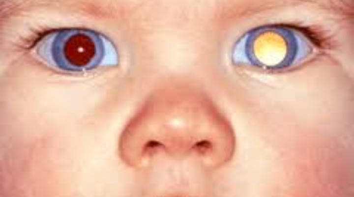 #2°Dalili ya awali ya kansa hii ni mtoto kuwa na kitu CHEUPE jichoni kinachong'aa hasa wakati wa giza (tazama pichani).Jicho moja au yote yanaweza kuathirika°Watoto wengi hupelekwa hospitali katika hatua mbaya,kwani wanakuwa hawajua kuwa mtotowao ana tatizo la kansa ya jicho.