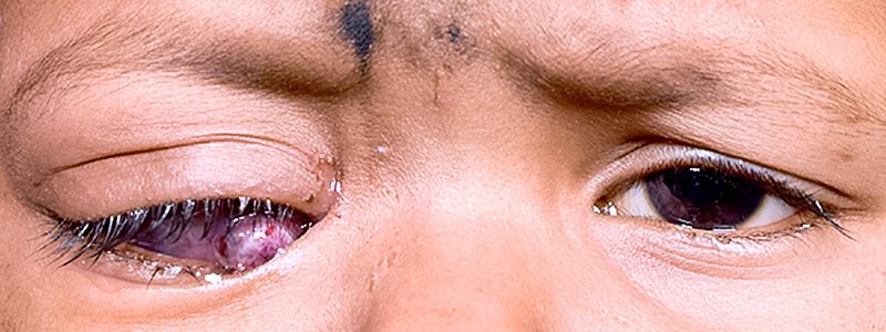 #3°Kansa hiyo katika hatua za mwisho huweza kuanza kukua na kuonekana kana uvimbe au kidonda kwenye sehemu ya jicho (tazama pichani).° Baadae huanza kumpa maumivu makali mtoto. Isipogundulika mapema huweza kusambaa sehemu zingine kama kwenye UBONGO n.k