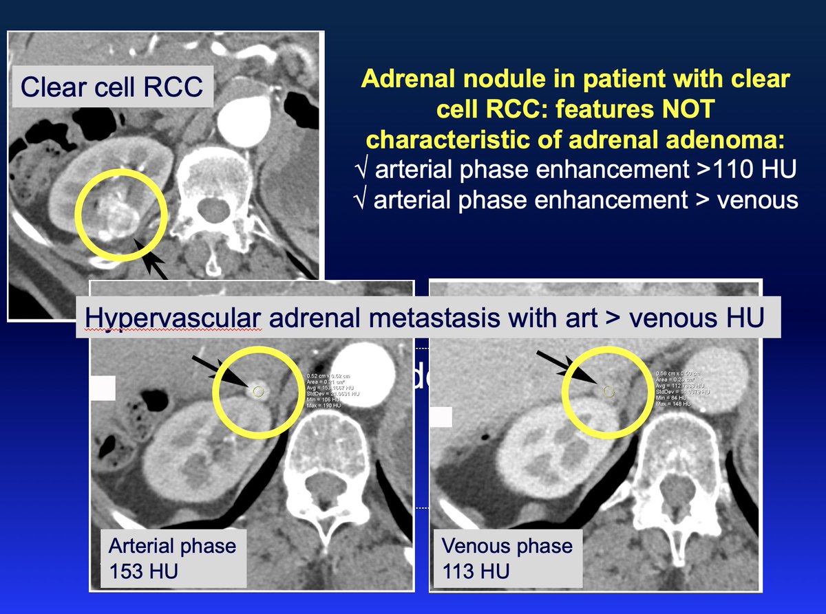 8/ Another caveat: pt with vascular renal mass & questionable adrenal nodule. Don't repeat imaging - measure arterial & venous HU. RCC met often hypervascular with arterial > venous & arterial >>>100 HU. Adenomas gradually enhance to peak on venous phase & ≤ 130 HU on venous.