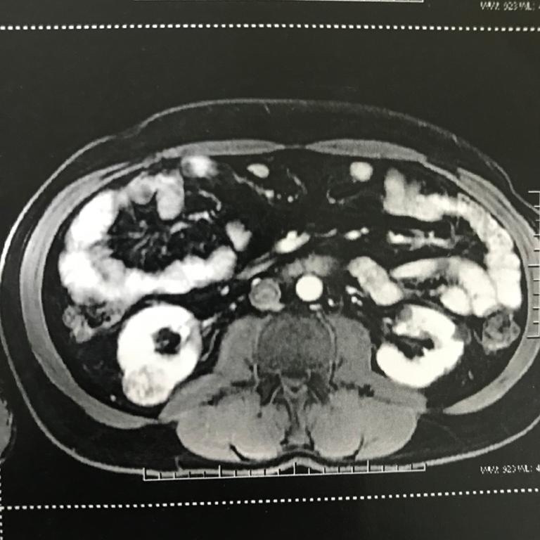 Carara_Daniel's tweet photo. 53 yo, male, bilateral renal tumors, 4cm posterior exophytic right mass, 3cm hilar endophytic left mass. Performed right laparoscopic partial nephrectomy with @ACavalli in january 2021.

#urology
#surgery 
#partialnephrectomy
#renalcancer https://t.co/THOfI0PWKh