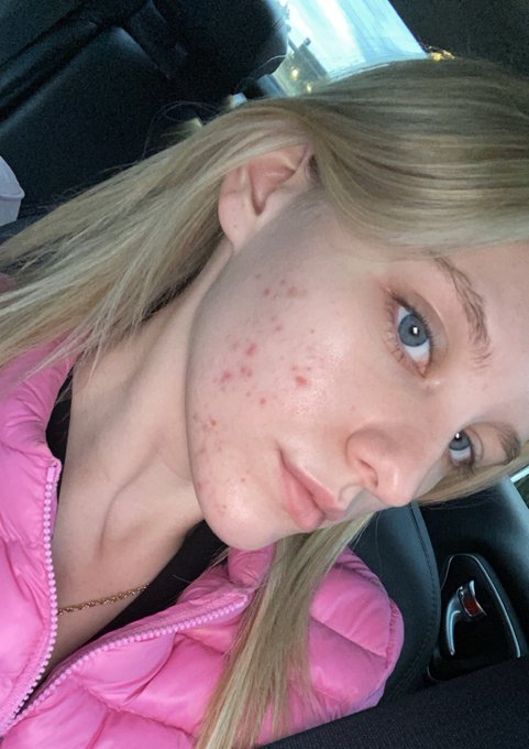 Idc, I don&rsquo;t want to hide my acne anymore. Yes I suffer from cystic acne, that gets so painful I can&rsquo;t