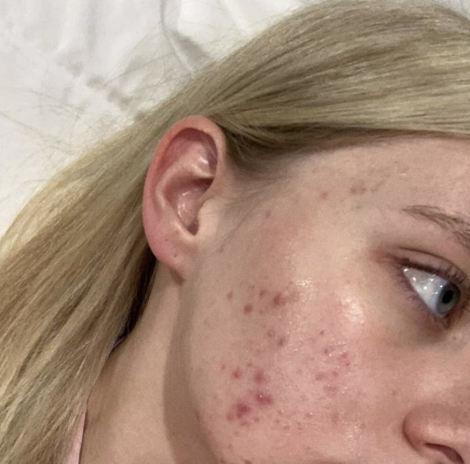 Idc, I don&rsquo;t want to hide my acne anymore. Yes I suffer from cystic acne, that gets so painful I can&rsquo;t