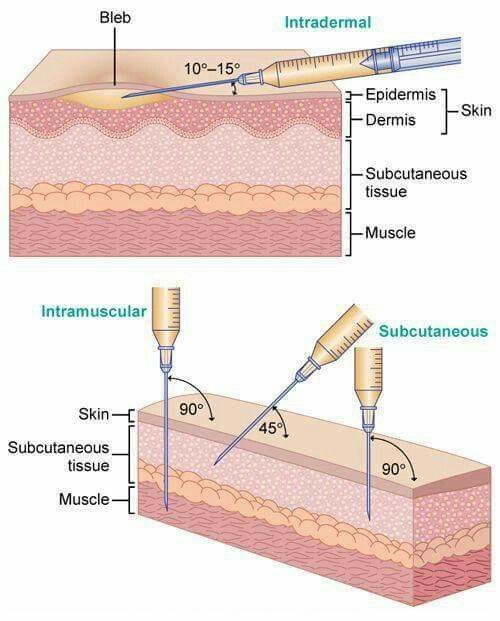 90 Degree Angle Injection 90-degree-angle-injection
