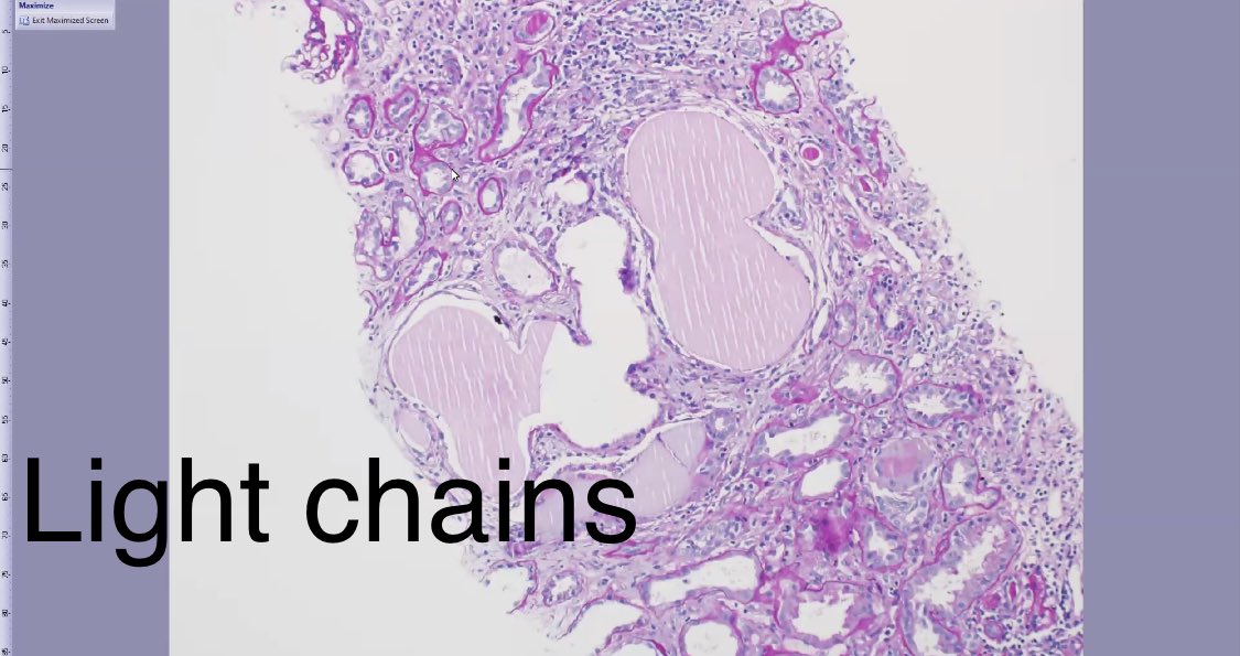 zainabo87's tweet photo. Great @arkanalabs zoom session today about cast nephropathies! #pathpearl hyalin and uromodulin casts are usually PAS postive (dark pink) while light chain casts are PAS negative and “glassy” @Nephro_Sparks @ssfarouk thank you! https://t.co/k4e7wvWR3s