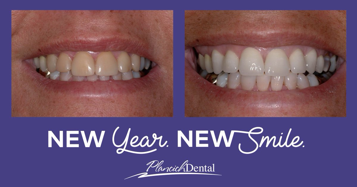 PlancichDental's tweet photo. New Year, thank goodness!
New Smile, we're here to help.
#OralHealth #SmileTransformation #IntegratedDentistry https://t.co/uLkYCeKo5w