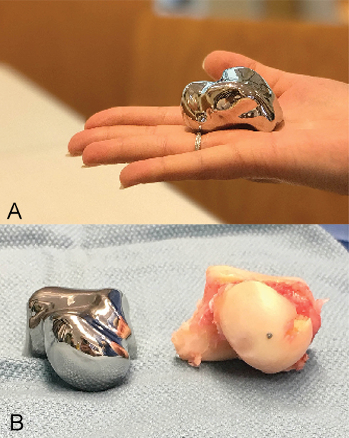 OrthoFeed's tweet photo. Rise of the Machines: Surgeons and Patients Benefit From 3D Printing
https://t.co/xotA80wpi8
@AAOS1 #AAOSNow #3Dprinting #3Dmodels #MedicalTechnology #CustomImplants #CustomInstruments #orthopedics #orthopaedics #PatientSpecific #PersonalizedOrthopedics #SurgicalPlanning https://t.co/hLxt0qj0on