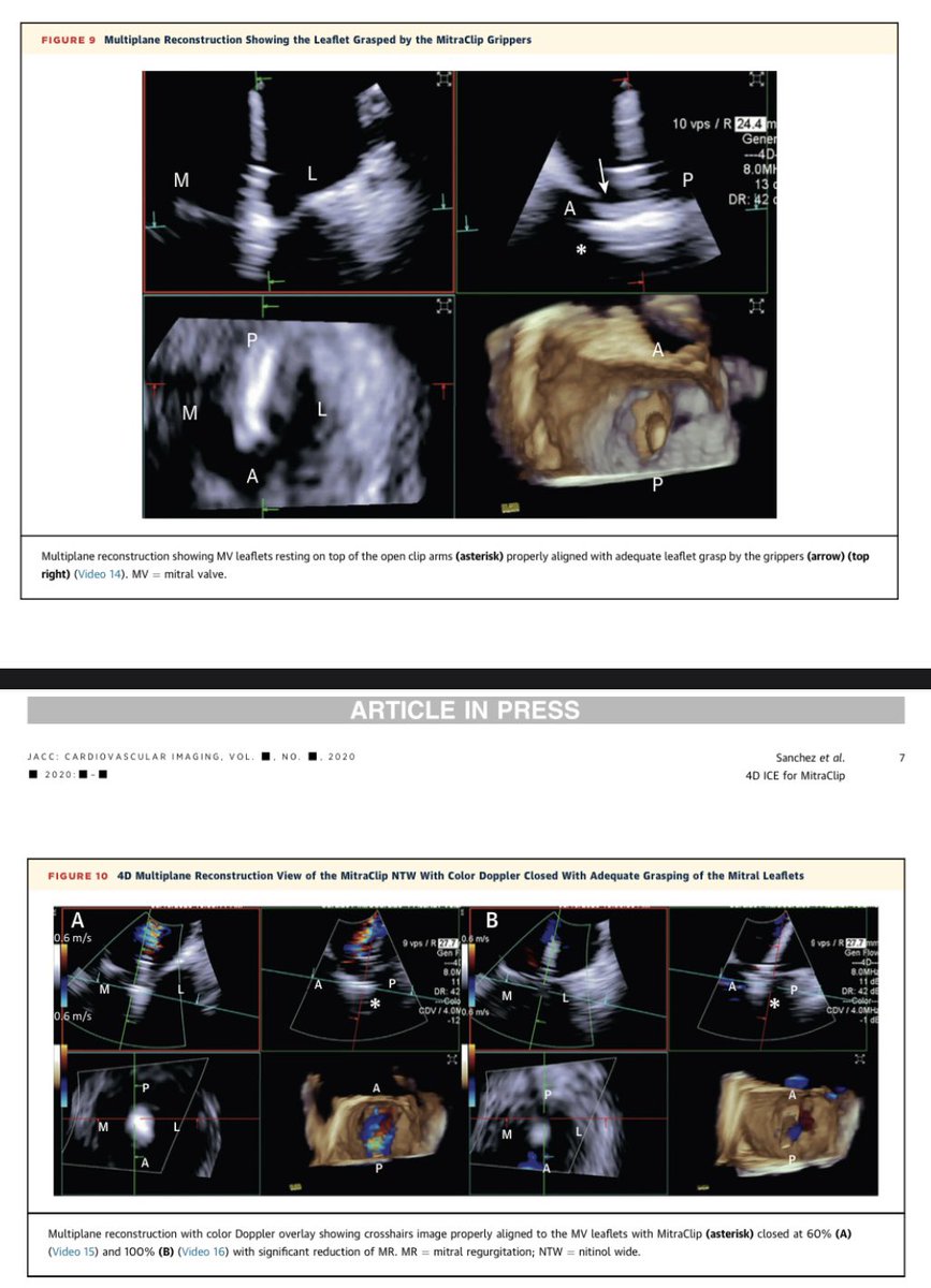 Dr. Gilbert Tang (@gilberttangmd) on Twitter photo just online! <a href="/JACCJournals/">JACC Journals</a> #JACCImg 4D ICE guidance in #MitraClip in pts who can’t get TEE. Great collaboration <a href="/caresans26/">Carlos E. Sanchez MD</a> <a href="/StevenYakubov/">Steven Yakubov</a> <a href="/JasonHRogersMD/">Jason Rogers</a> GaganSingh jacc.org/doi/10.1016/j.… <a href="/PSorajja/">Paul</a> <a href="/mirvatalasnag/">MIЯVΛƬ #IC</a> <a href="/hahn_rt/">RTHahnMD</a> <a href="/HamidNadira/">Nadira Hamid</a> <a href="/EdwinHoMD/">Edwin Ho</a> <a href="/azeemlatib/">Azeem Latib</a> <a href="/chrismeduri/">Chris Meduri, MD MPH</a> just online! <a href="/JACCJournals/">JACC Journals</a> #JACCImg 4D ICE guidance in #MitraClip in pts who can’t get TEE. Great collaboration <a href="/caresans26/">Carlos E. Sanchez MD</a> <a href="/StevenYakubov/">Steven Yakubov</a> <a href="/JasonHRogersMD/">Jason Rogers</a> GaganSingh jacc.org/doi/10.1016/j.… <a href="/PSorajja/">Paul</a> <a href="/mirvatalasnag/">MIЯVΛƬ #IC</a> <a href="/hahn_rt/">RTHahnMD</a> <a href="/HamidNadira/">Nadira Hamid</a> <a href="/EdwinHoMD/">Edwin Ho</a> <a href="/azeemlatib/">Azeem Latib</a> <a href="/chrismeduri/">Chris Meduri, MD MPH</a>