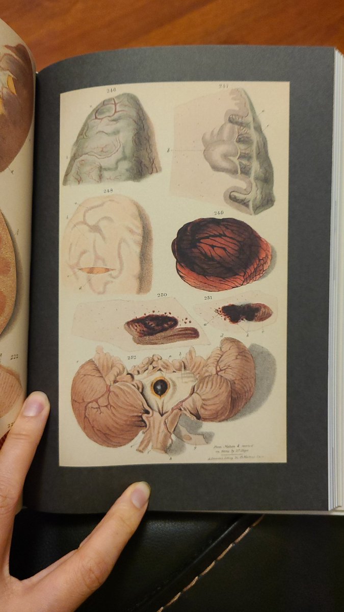a medical professional in the 1840s would've seen TONS of TB, then called consumption due to the way TB appeared to waste and consume the bodies of its sick. it classically attacks the lungs but MacDonald would've known it can manifest in the bowel, kidneys, and even the brain
