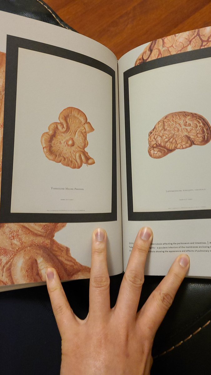 a medical professional in the 1840s would& #39;ve seen TONS of TB, then called consumption due to the way TB appeared to waste and consume the bodies of its sick. it classically attacks the lungs but MacDonald would& #39;ve known it can manifest in the bowel, kidneys, and even the brain
