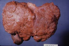 Goodsir is right! that liver ISN'T cirrhotic (i added a photo of one that is). it actually looks very healthy and normal! gall is a period accurate term for bile. many GI issues at the time were blamed on sluggish or blocked flow of gall, which is why Goodsir was looking for it