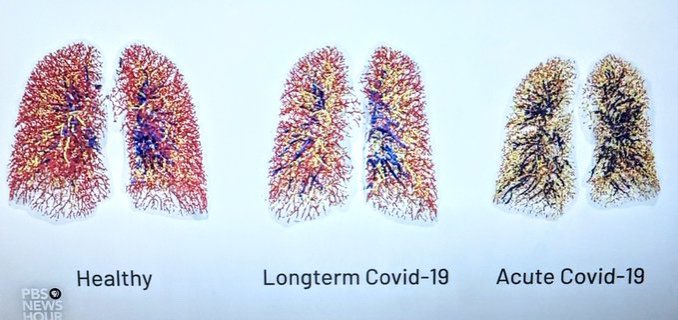 3) Many others are highlighting this issue. Look how even longer term  #COVID19 survivors’ lungs look compared to healthy. Lots of damage long term, even if not severe illness.  https://twitter.com/dianaberrent/status/1349725613670719490