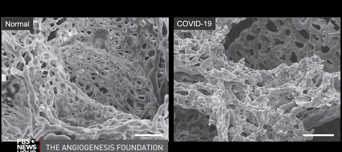 4) look how normal lung tissue compares to people who died of  #COVID19
