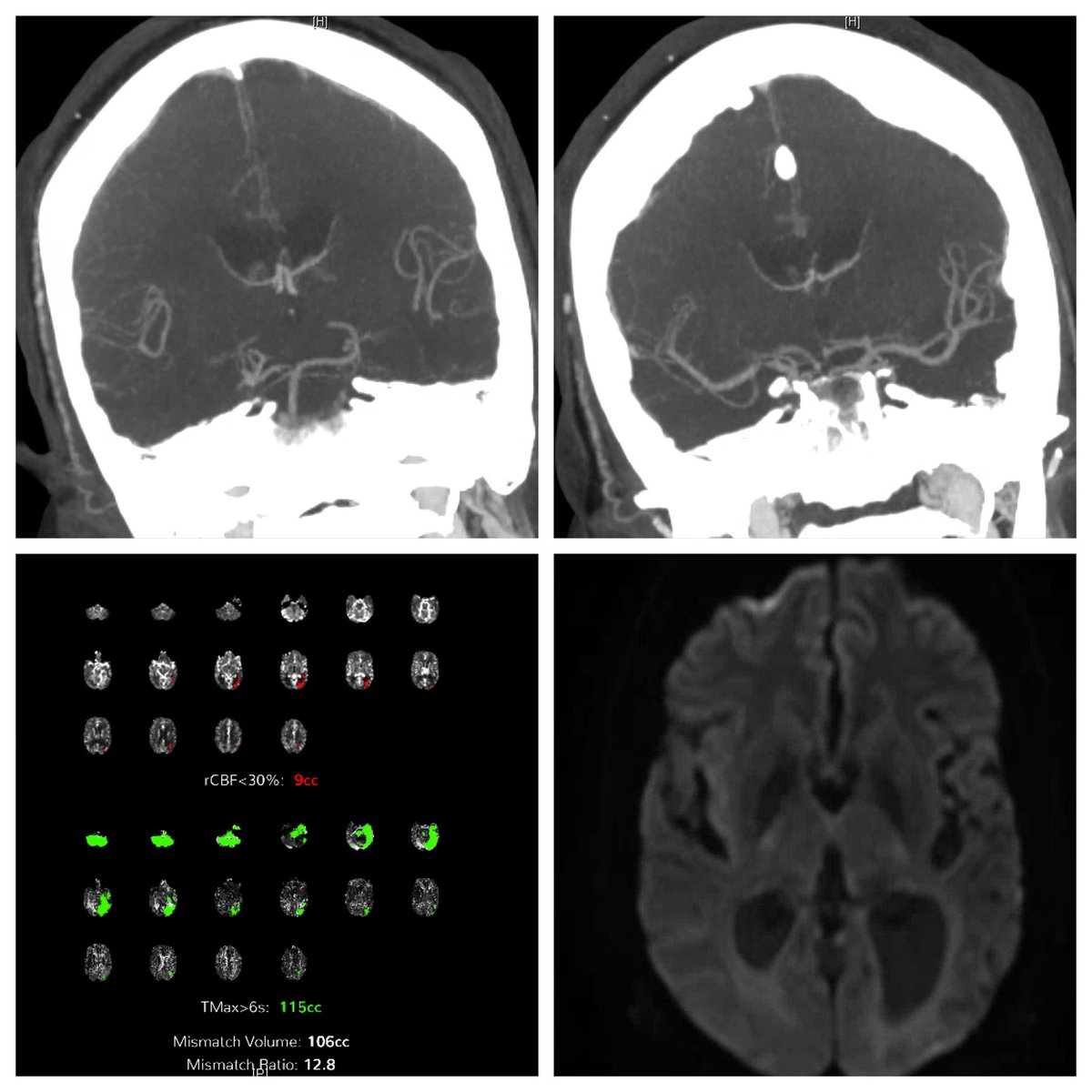 DavidAltschulMD's tweet photo. Patient presents with right sided jerking movements and then weakness. #strokemimics #ctp showing #postictal state As it turns out posterior fossa hypoperfusion postictally is a risk for sudden unexpected death with #epilepsy; more reasons to do CTP https://t.co/o8r9Z56Rss