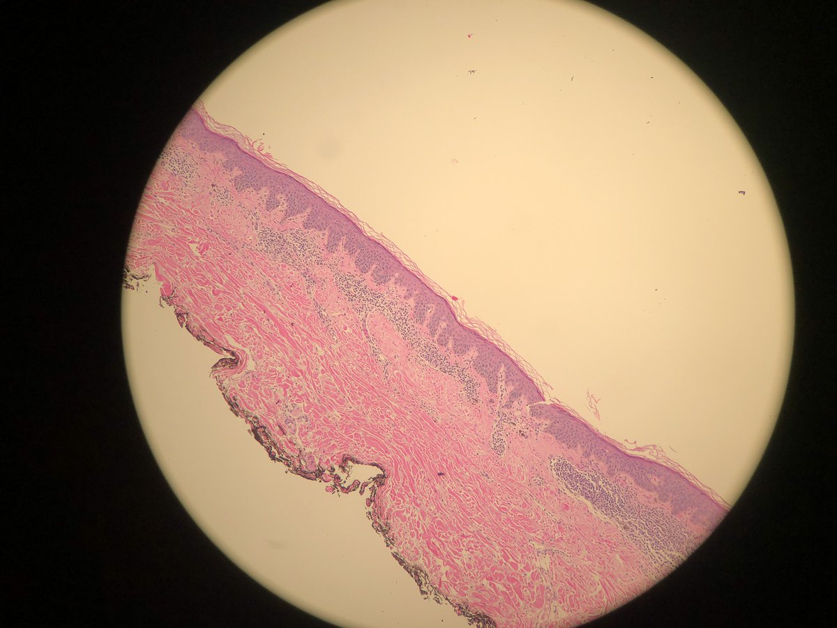 nerdyDP's tweet image. R/o atypical nevus. Biopsy looks ok not exciting 😏.  But IHC result changes the deal 🥳🥳🥳 Want to guess what the stain is?