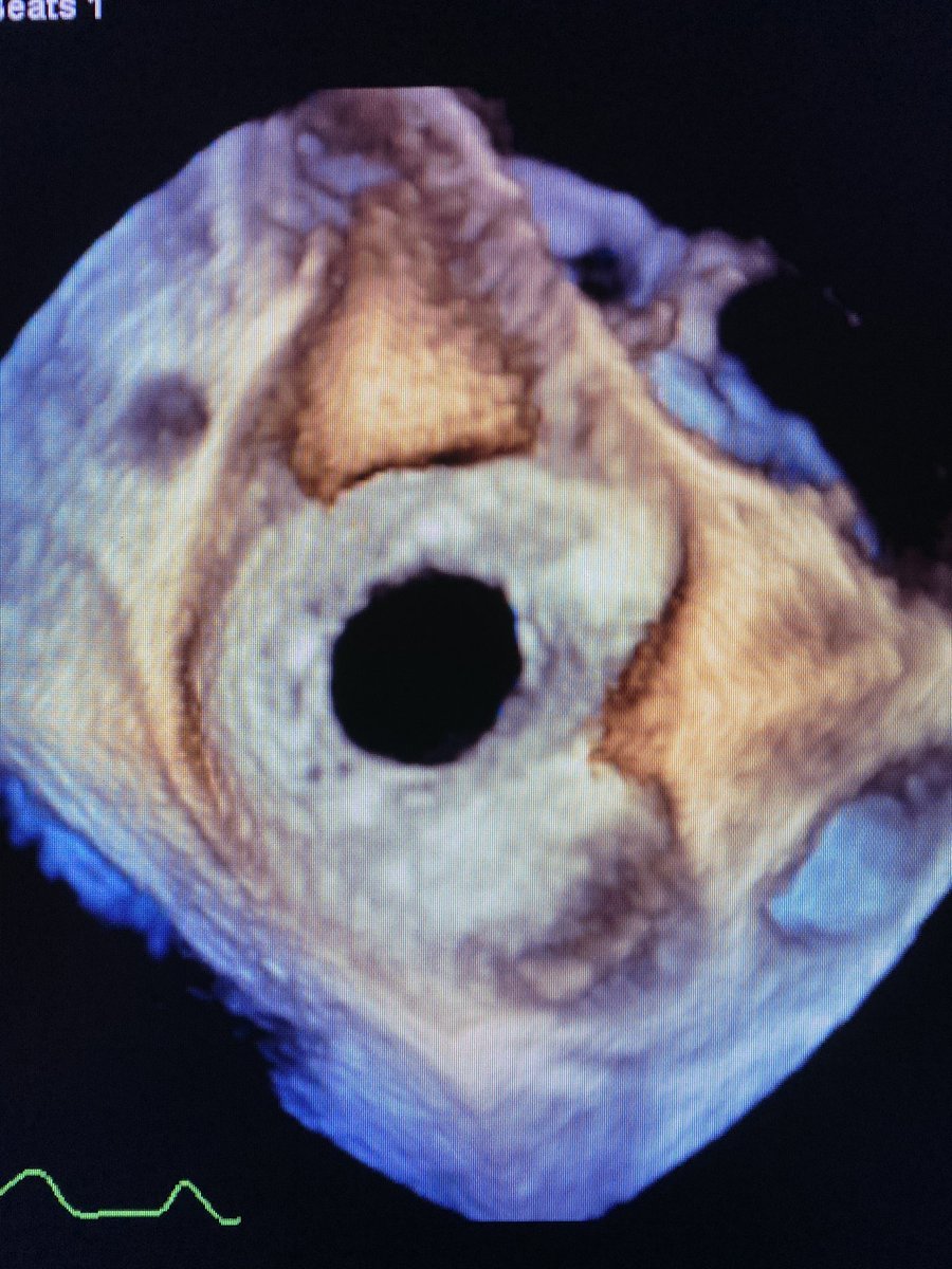 LathaSub_MD's tweet photo. ASD Closure @NYPQueens #echofirst #3D https://t.co/cMfliF8kgi