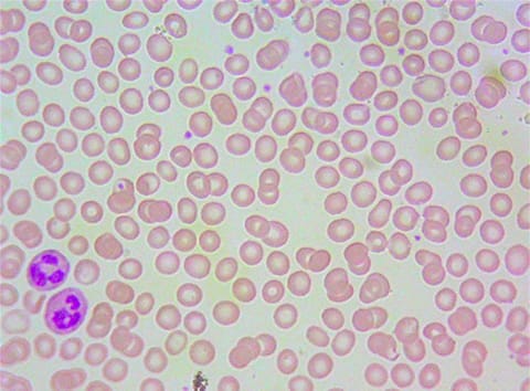 Our scanner searchs for morphological red and white blood cell abnormalities from the blood film via sampling in a number of images from the slide.