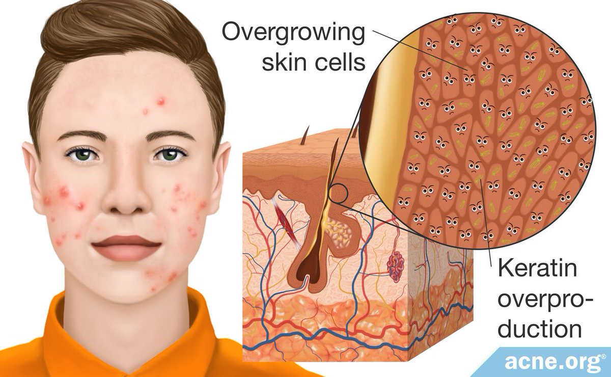 Kelainan yang terjadi pada kulit adalah:- Penebalan epidermis akibat trauma mekanik berulang, sehingga kandungan air pada kulit berkurang dan sawar kulit terganggu, dan- Ketidakseimbangan mikroorganisme dan gangguan imunitas bawaan