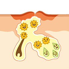 Kelainan yang terjadi pada kulit adalah:- Penebalan epidermis akibat trauma mekanik berulang, sehingga kandungan air pada kulit berkurang dan sawar kulit terganggu, dan- Ketidakseimbangan mikroorganisme dan gangguan imunitas bawaan
