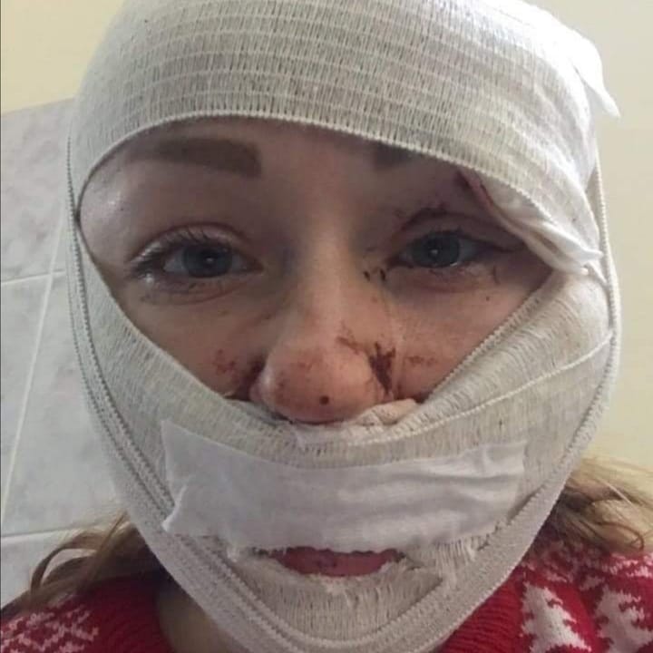 esenyalikdd's tweet photo. Anna Butım boşanmak istediği, hakkında uzaklaştırma kararı çıkarttığı erkek tarafından falçatayla saldırıya maruz kaldı. Hastanede tedavi görüyor ve yüzü felçli kaldı. Hala fail tarafından ölüm tehditleri alıyor.
#AnnaButim #mesutozturkmentutuklansin https://t.co/DA7tJol6kv